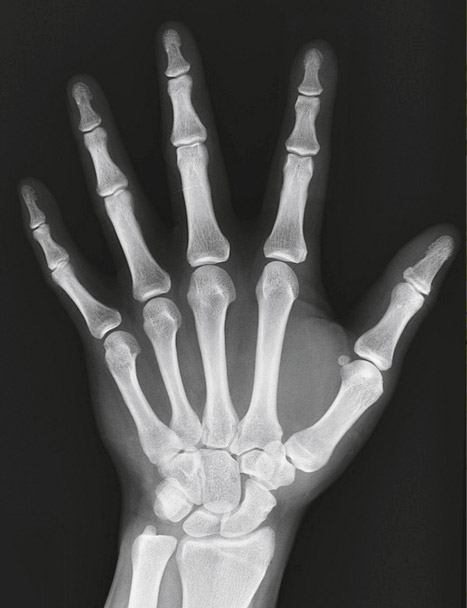 X-RAYS were discovered by accident in 1895.
